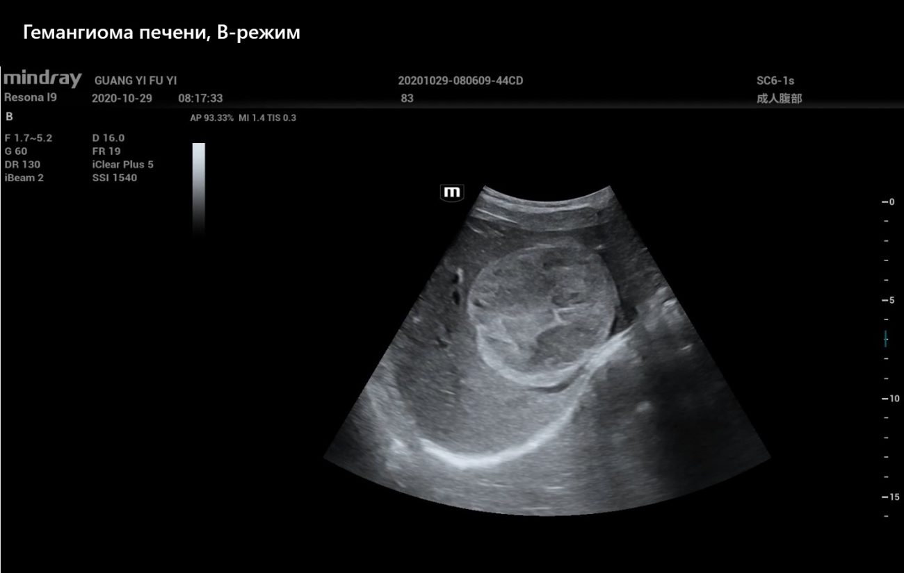 Гемангиома печени, В-режим