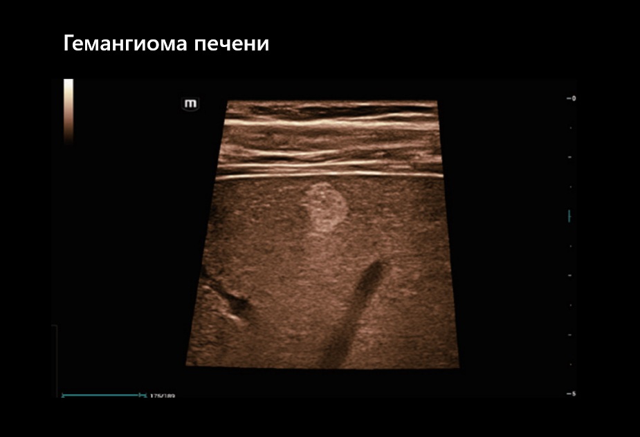 Гемангиома печени