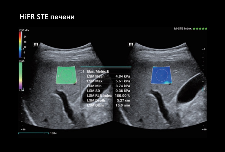 HiFR STE печени