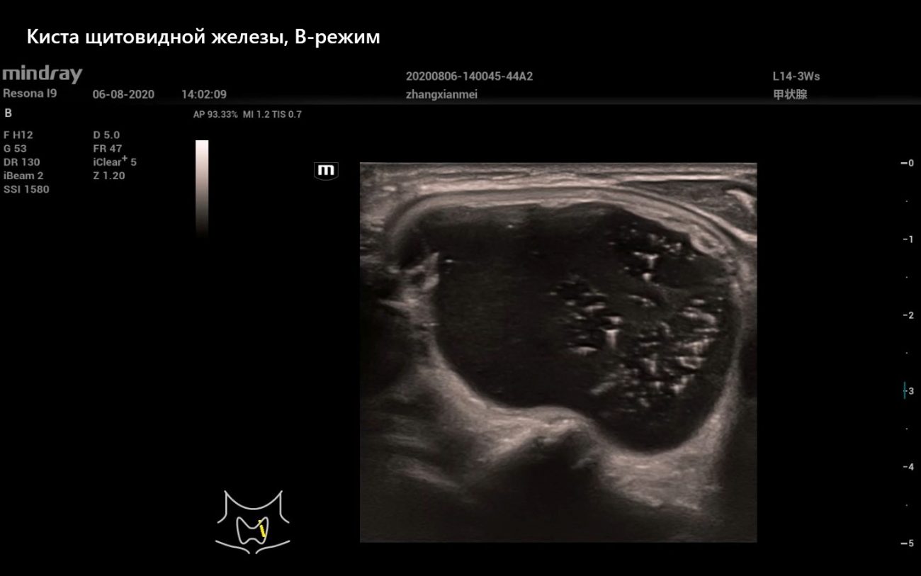 Киста щитовидной железы, В-режим