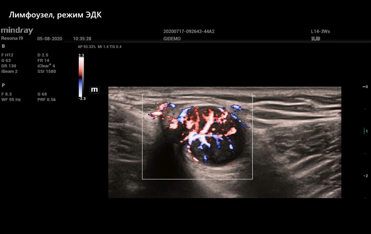 Лимфоузел, режим ЭДК