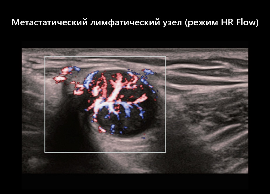 Метастатический лимфатический узел (режим HR Flow)
