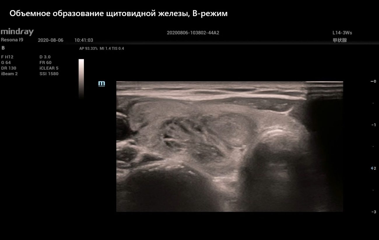 Объемное образование щитовидной железы, В-режим