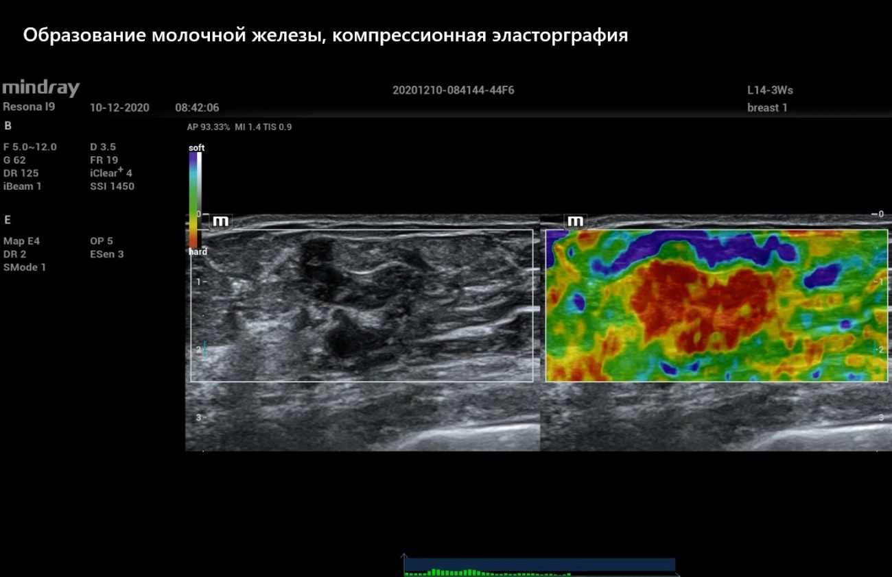 Образование молочной железы, компрессионная эласторграфия