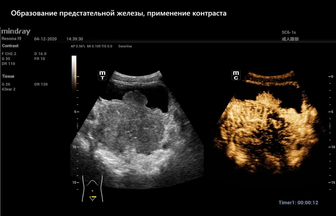 Образование предстательной железы, применение контраста