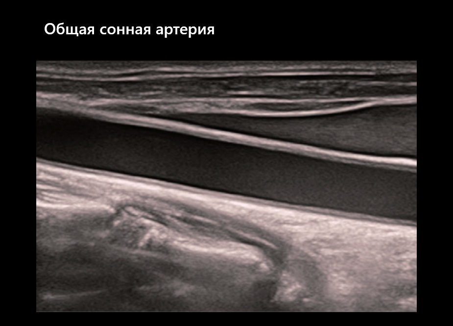 Общая сонная артерия