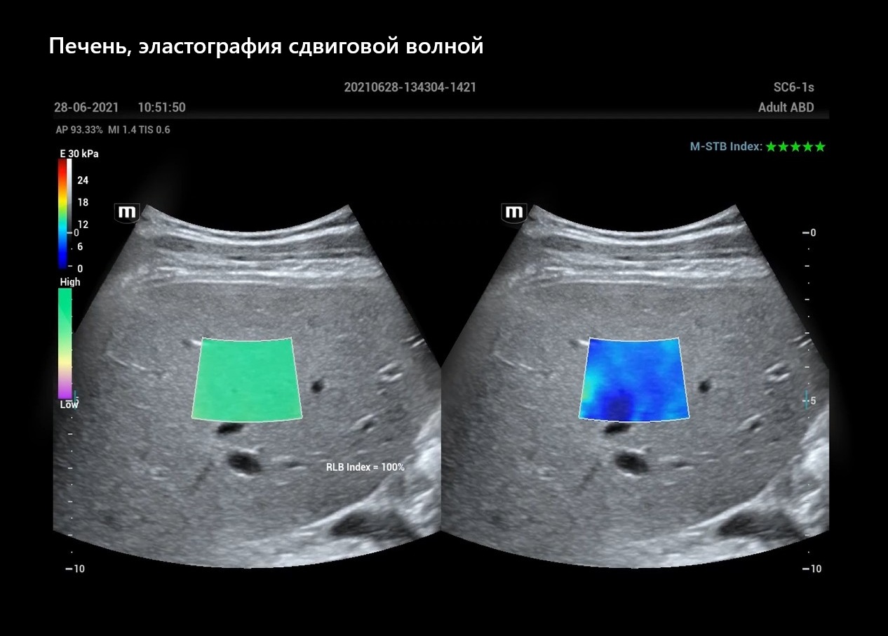 Печень, эластография сдвиговой волной
