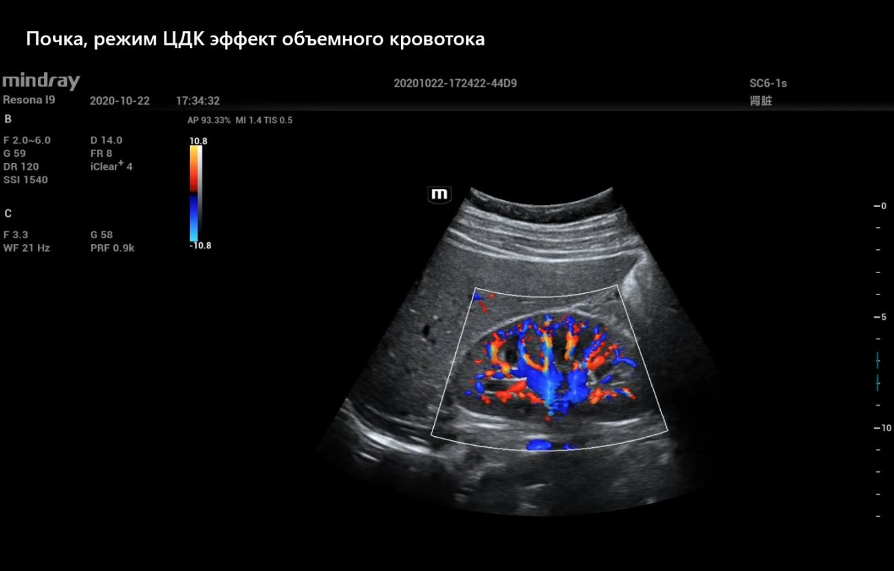 Почка, режим ЦДК эффект объемного кровотока