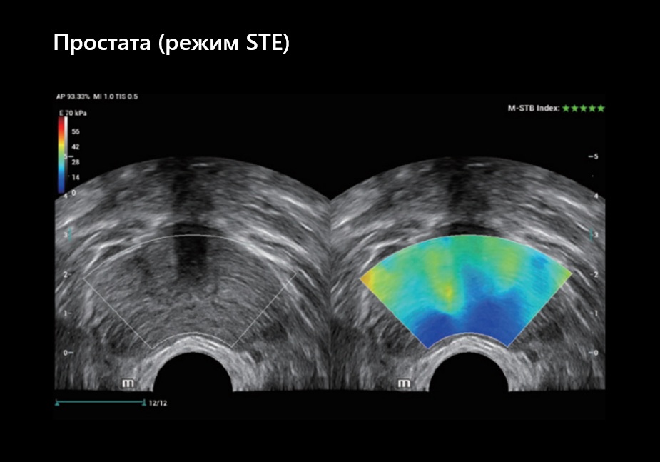 Простата (режим STE)