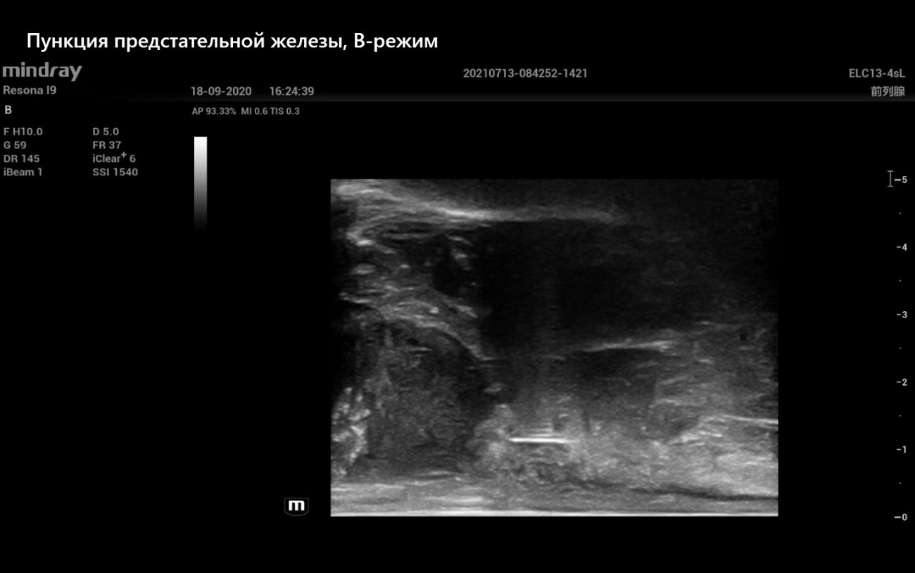 Пункция предстательной железы, В-режим