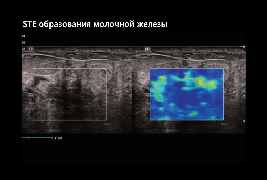 STE образования молочной железы