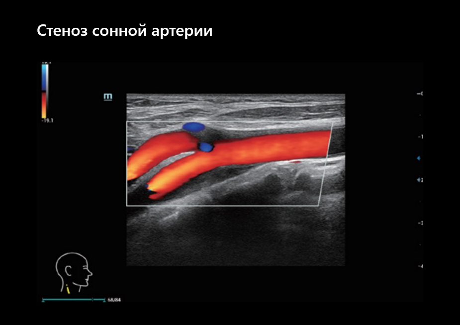 Стеноз сонной артерии