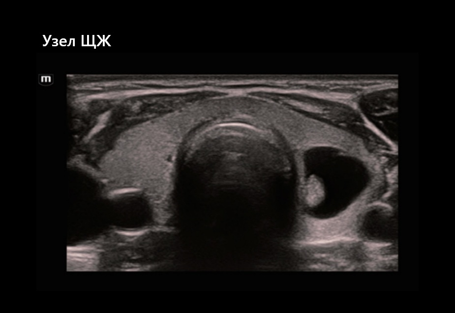 Узел ЩЖ