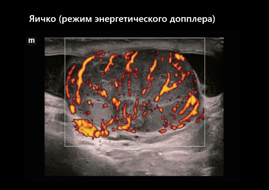 Яичко (режим энергетического допплера)