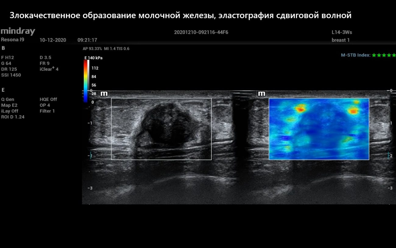 Злокачественное образование молочной железы, эластография сдвиговой волной